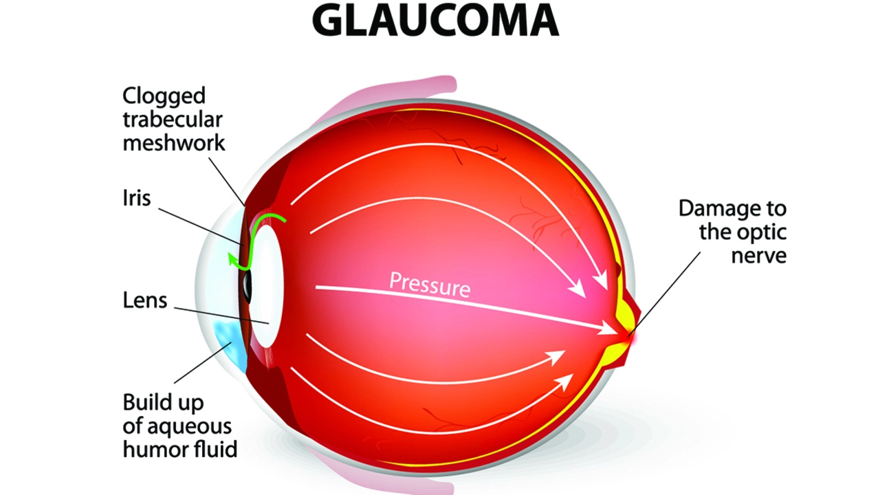 How brimonidine tartrate helps manage symptoms and progression of open-angle glaucoma